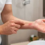 En person pekar på ett rött utslag på handleden, möjligen svamp på huden.