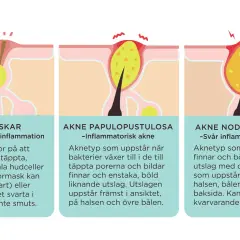 Illustrationer visar olika typer av hormonella utslag: pormaskar, inflammatorisk akne och svår akne med djupa varblåsor.