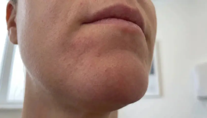 Närbild på en persons haka och mun. Huden runt munnen är röd och irriterad, vilket kan vara tecken på perioral dermatit, ibland kopplat till klimakteriet.