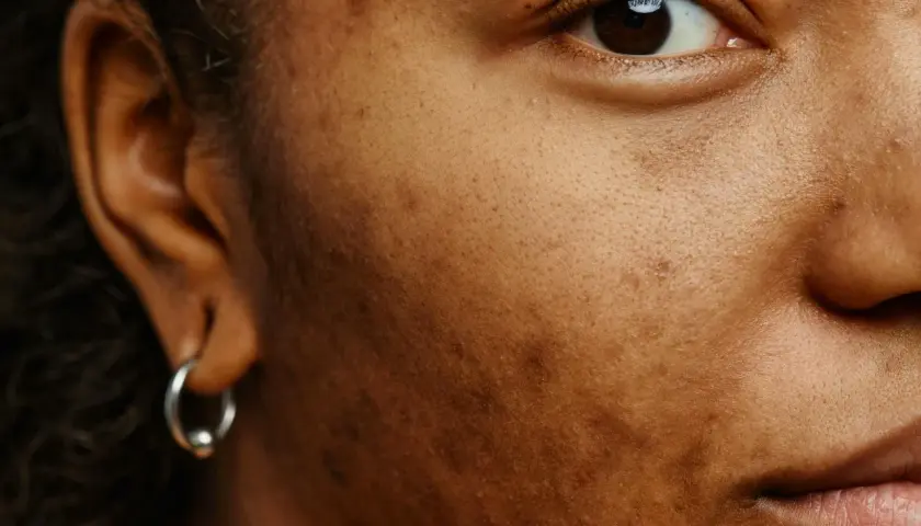 Närbild på ett ansikte med melasma. Örat med en silverring syns till vänster, och en del av ögat och munnen till höger.