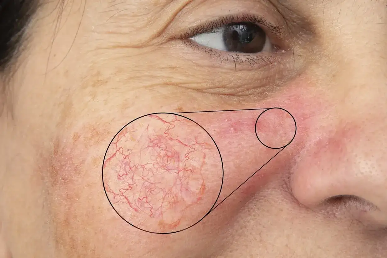 N&auml;rbild p&aring; en persons kind med synliga blodk&auml;rl och rodnad, typiskt f&ouml;r rosacea hud. F&ouml;rstorad cirkel visar detaljer av k&auml;rlen.