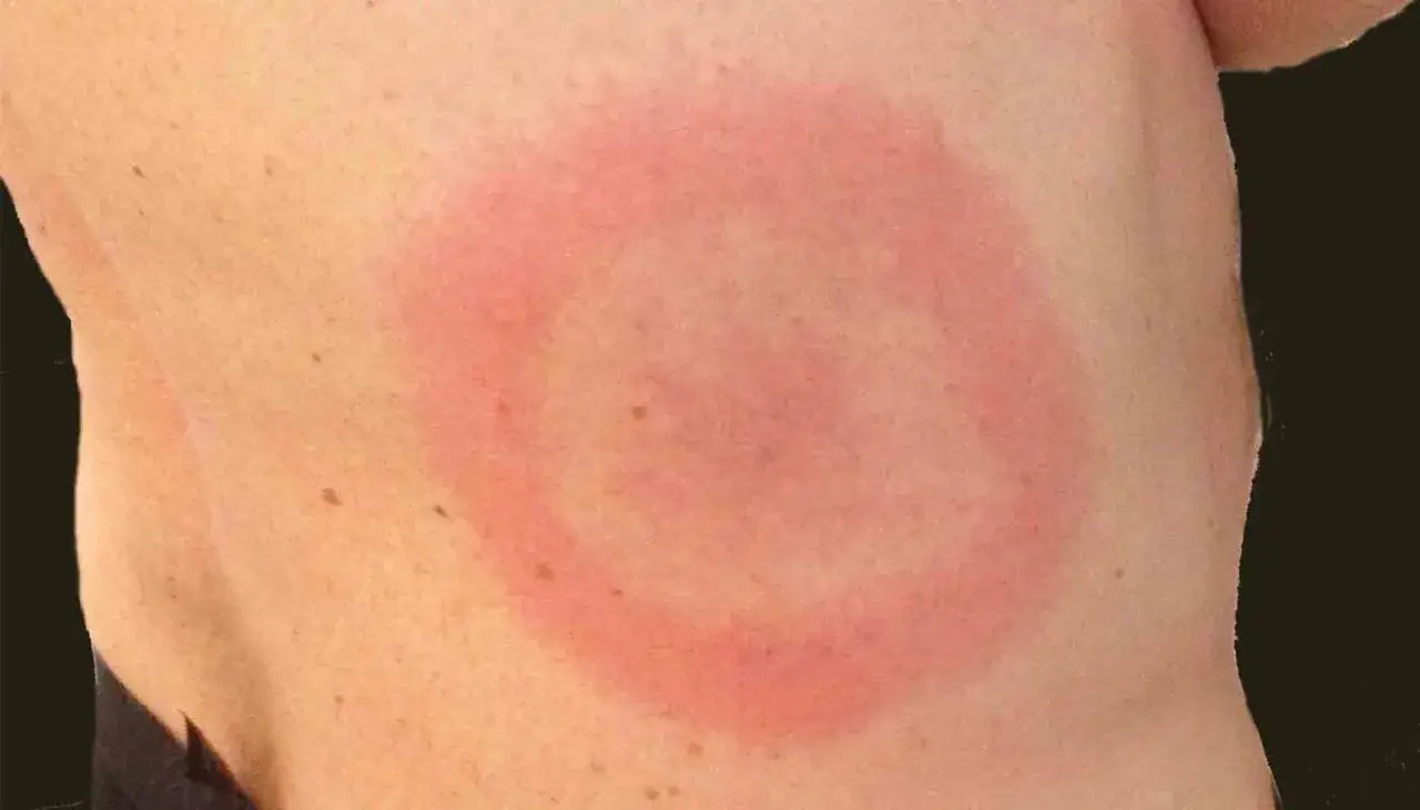 Rött, ringformat utslag på huden, kan vara ett stress utslag.