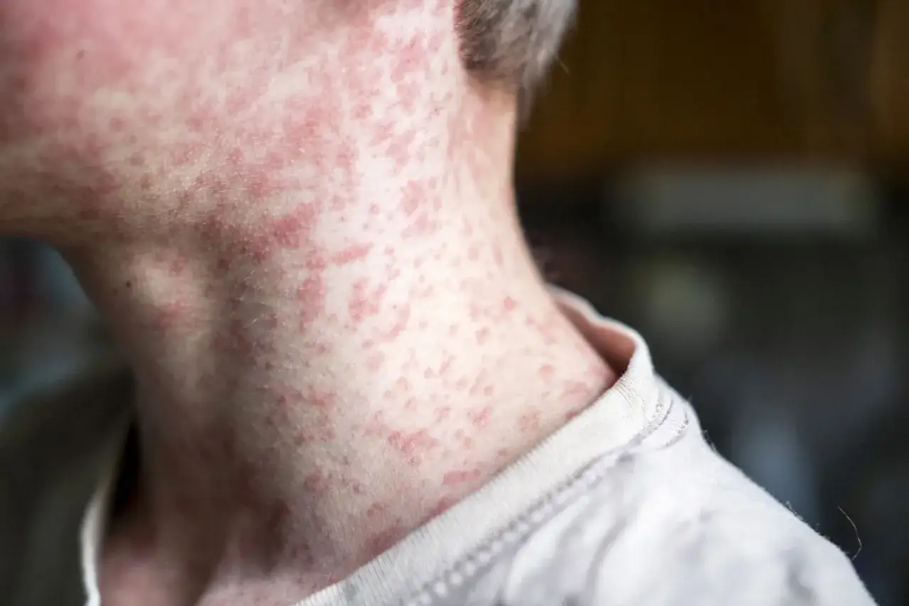 N&auml;rbild p&aring; en persons hals och nacke med utslag som tyder p&aring; rosacea p&aring; kroppen.