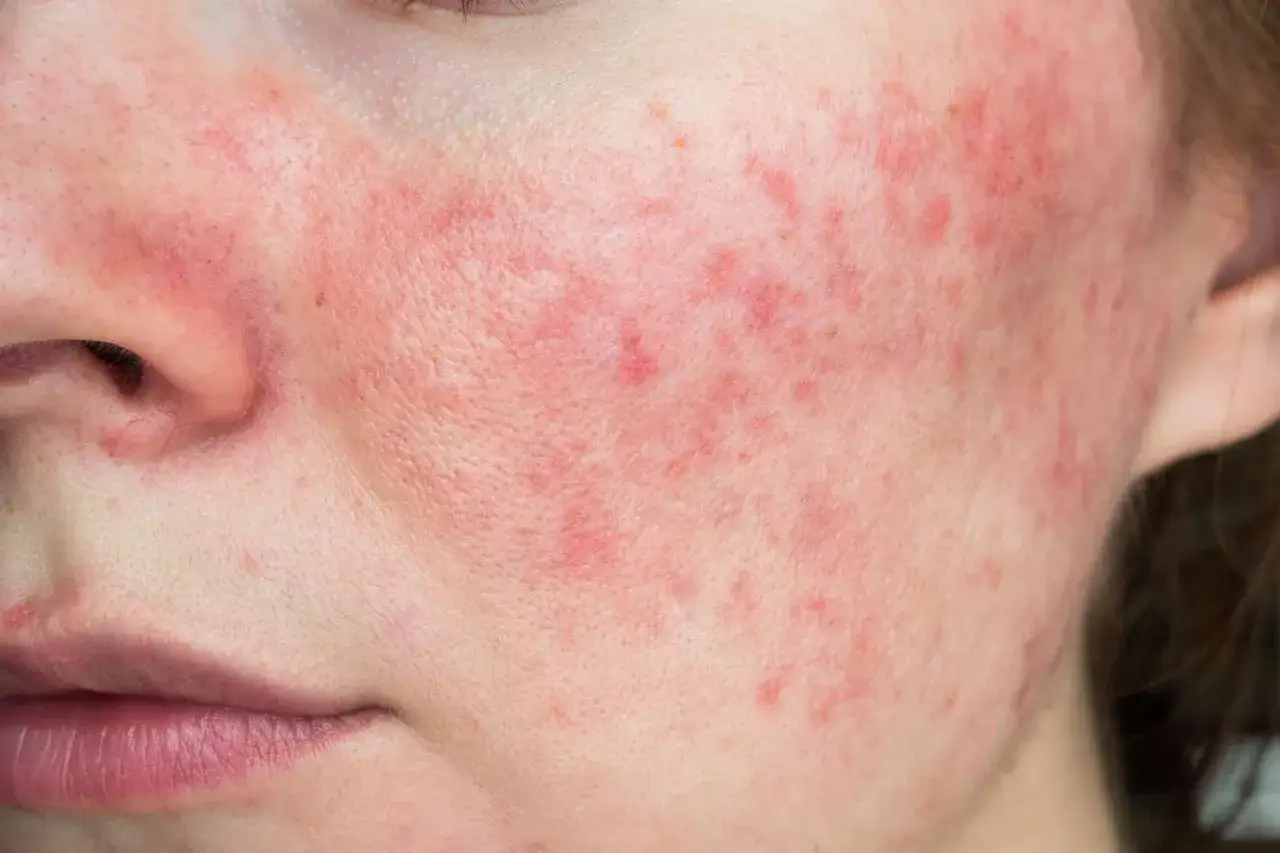 N&auml;rbild p&aring; en persons ansikte med rodnad och sm&aring; bl&aring;sor i ansiktet, troligen rosacea.