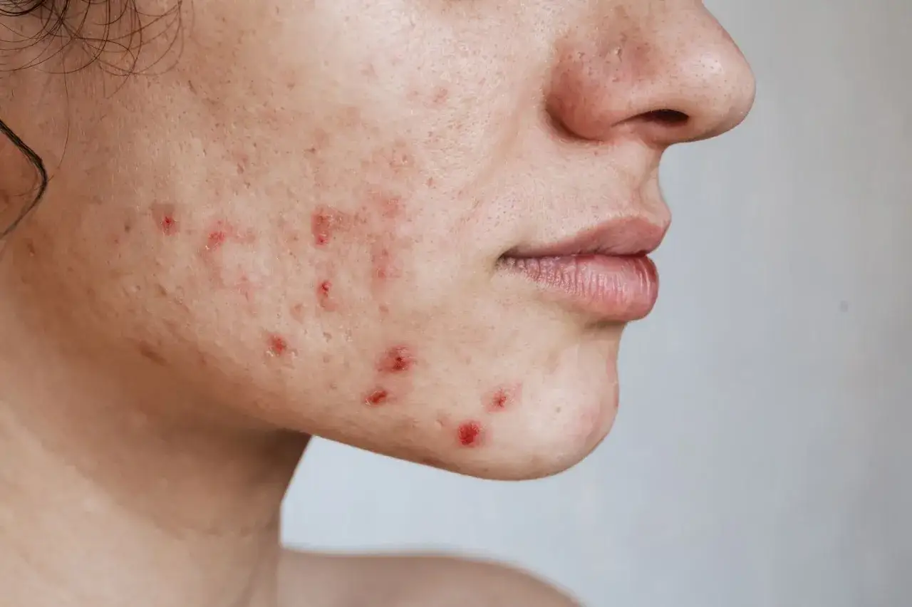 N&auml;rbild p&aring; en persons kind med r&ouml;da, inflammerade hormonella utslag och &auml;rr.