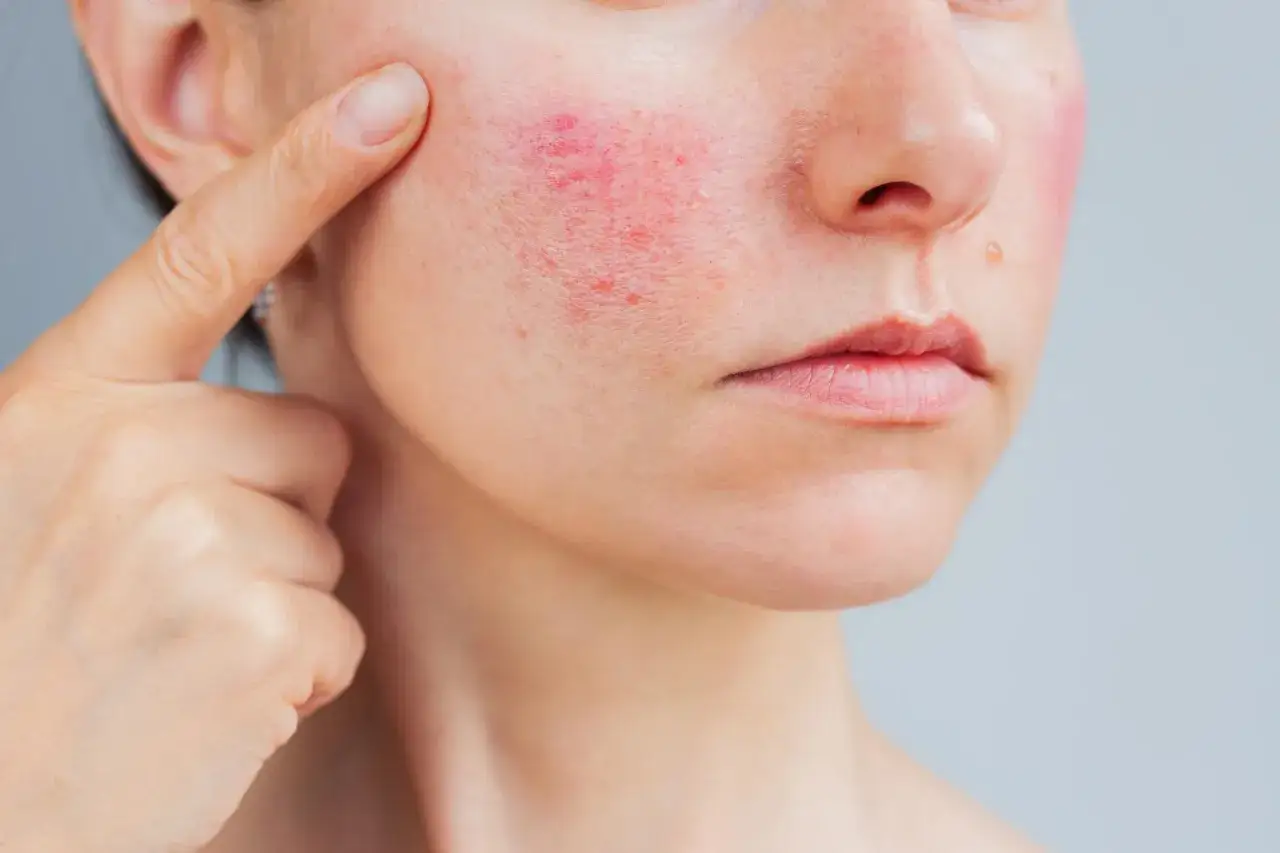 Nära bild på en kvinna som pekar på sin kind där rodnad och utslag syns, vilket indikerar behovet att behandla rosacea.